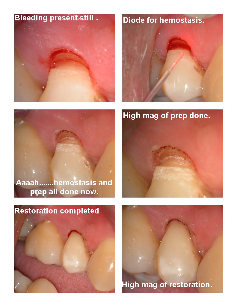 Class V with bleeding pg 2.jpg